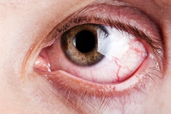 glaucoma