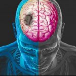 avc-cerebro