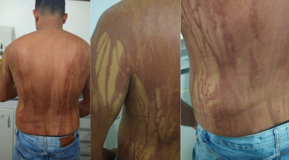OLEO E QUEIMADURAS NA PRAIA EM ILHÉUS